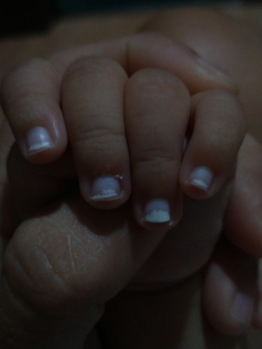 Tanung ko Lang po Kung bakit may spot na kulay Puti Sa kuko Ni baby??4months palang po sya