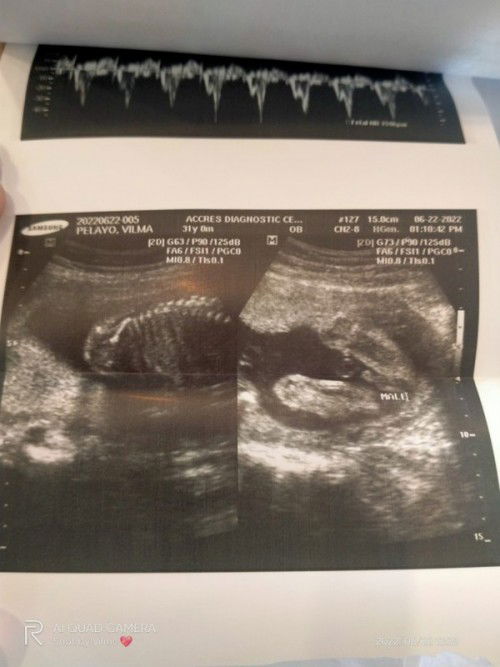 Hi mga momsh.. Sure na po ba baby boy? Thank you 🥰