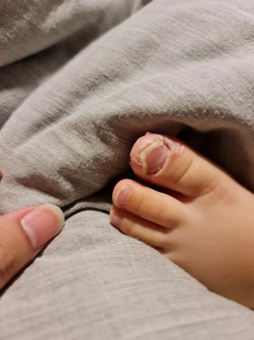 Toe nail peeling