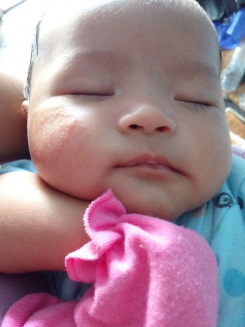 Jamur bekas asi ? Atau alergi