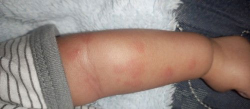 Tangan sama kakinya merah merah