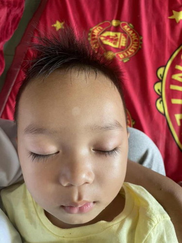 จุดขาวๆตรงหน้าผากใช่เกลื้อนไหมคะ