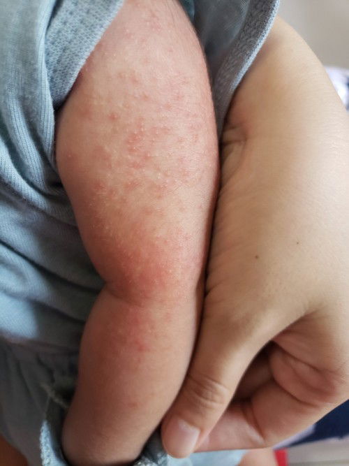 Mohon info bun mungkin ada yg sama babynya begini, kulitnya beruntusan merah di seluruh badan 😔