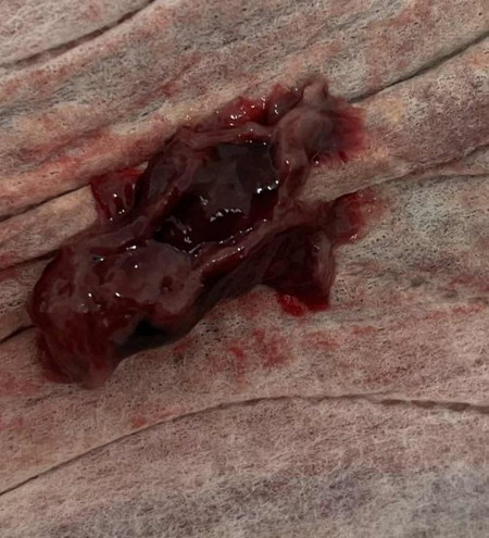 Period berketul macam daging