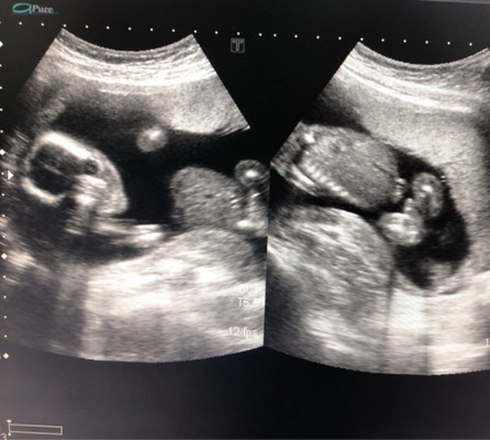 ช่วยดูเพศลูกให้ทีค่าา🙏🙏 ทีม พย ได้เพศไหนกันบ้างเอ่ย (ช่วยตอบเม้นที)