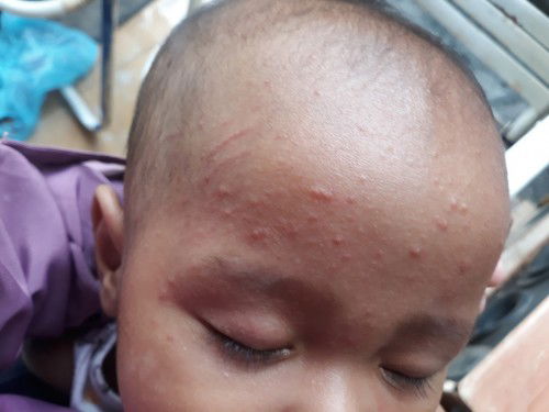 Apakah ini biang keringat ?