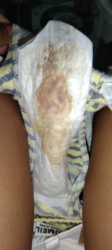 Brown Discharge ??