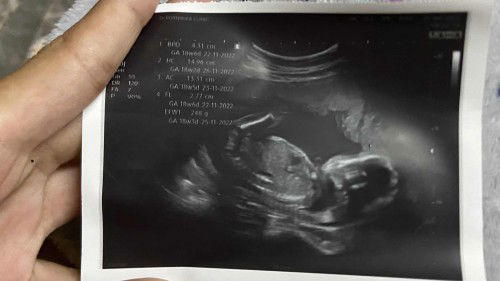 แม่ๆทีมพ.ยมาอวดรูปอัลตราซาวด์ลูกๆกันจ้า ท้องแรก