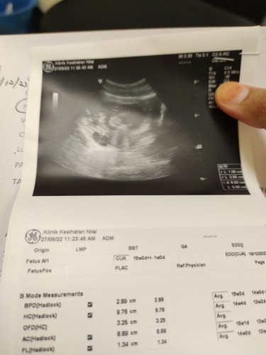 Siapa kat sini yang pernah hamil Lpas tu ad cyst? Tdi baru je scan dkt klinik kerajaan