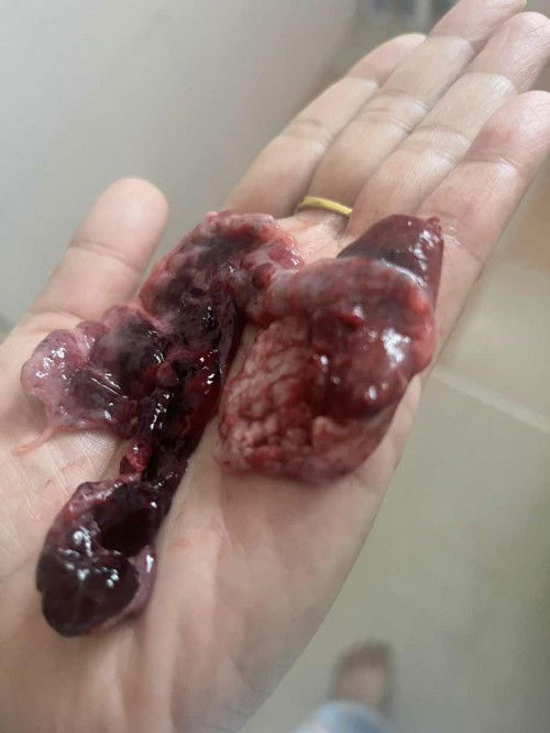 สรุปท้องลม…??