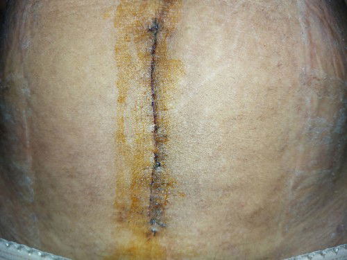 Tahi ng CS, Ask ko lang po if sa kaso po ng tahi ko.