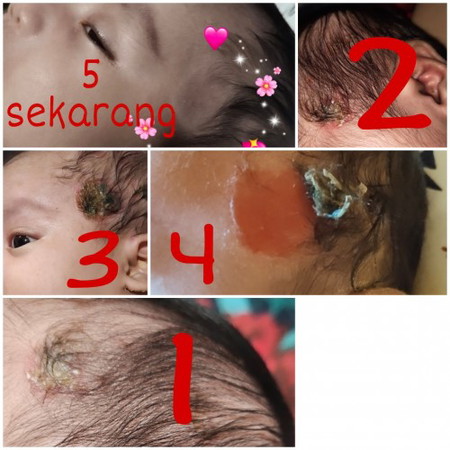 Bekas alergi di kepala bayi bisa tumbuh rambut?
