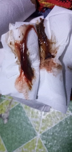 Normal ba magkaroon ng discharge, 25 weeks pregnant