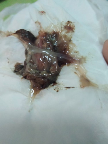 ท้อง39+4week กวาดกระตุ้นปากมดลูก