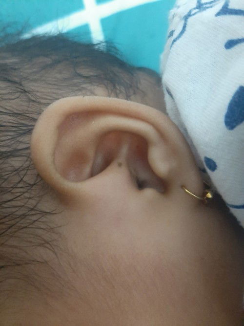 Telinga anak ada lubang kecil Dan bengkak