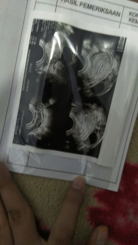 Tentang kehamilan /Usg