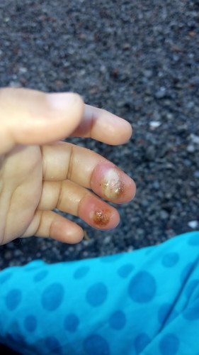 Bunda, mo nanya nih
Obat buat luka bakar anak apa yaaa
Soalnya sudah berhari-hari ngga sembuh.
