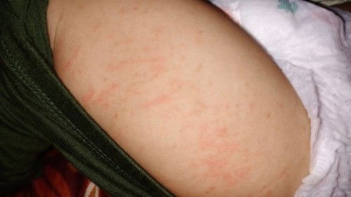 Bayi 10 bulan gatal2