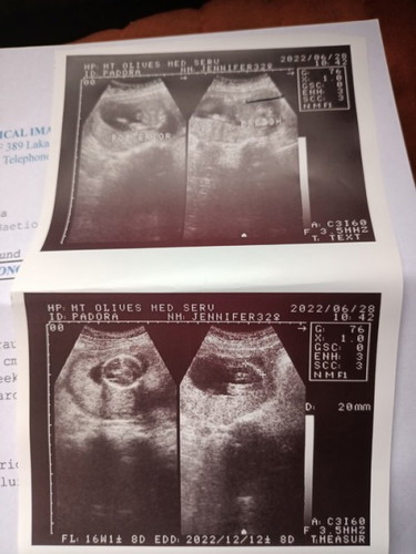 Tanong ko Lang ano po ibig sabihin Ng Naka lagay Sa ultrasound ok Lang po Si baby ko ano po Yung bre