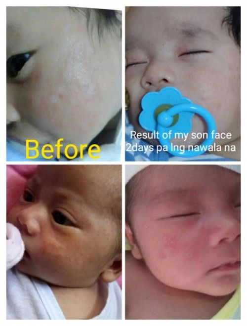 How to treat Baby Eczema😊
Hello mga Mommies sino mga baby dito nakaranas ng ganito ngayon?