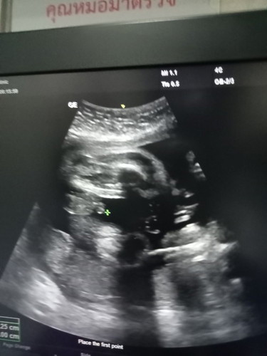 31weekรู้เพศสักที