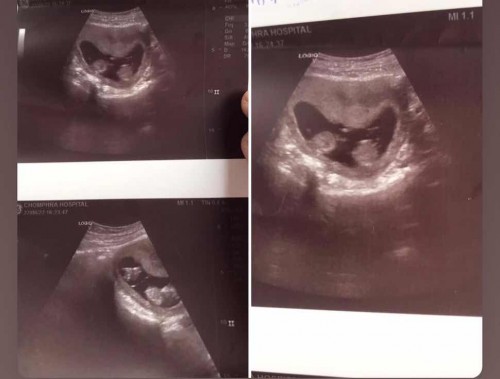 แบบนี้ลูกแฝดไหมค่ะ พึ่งท้องแรกค่ะ.