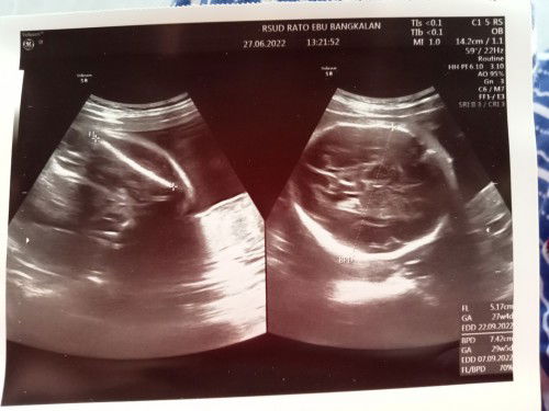 USG 28 minggu ke atas