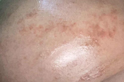 Puppp pada kehamilan