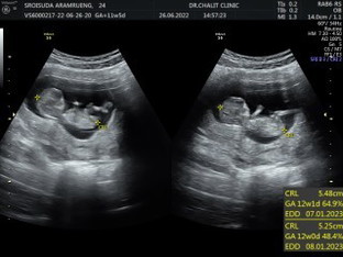 ตั้งครรภ์12week