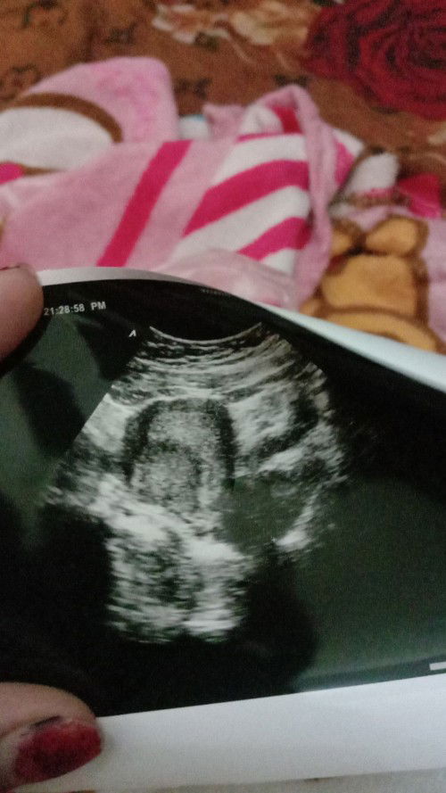 certa nya habis usg hpht 21 april hrus nya udh 9wek 4hri bun🥺agak sedih keterangan doktr postp hmil