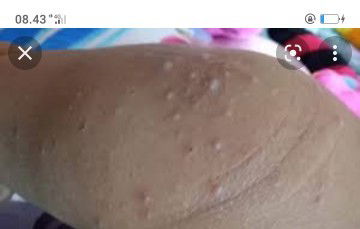 Mohon jawabannya buibu ,anak saya bintik berair di bagian siku kanan kiri dan lutut kanan kiri