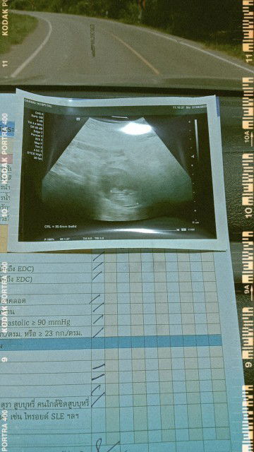 10สัปดาห์1วันแล้วค่ะ เบ๋บี๋น้อยปกดีดีค่ะ หัวใจดวงน้อยๆเต้นดีค่ะ💗