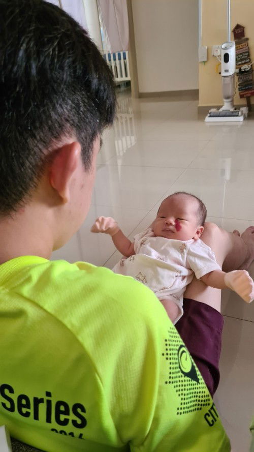 infantile hemangioma