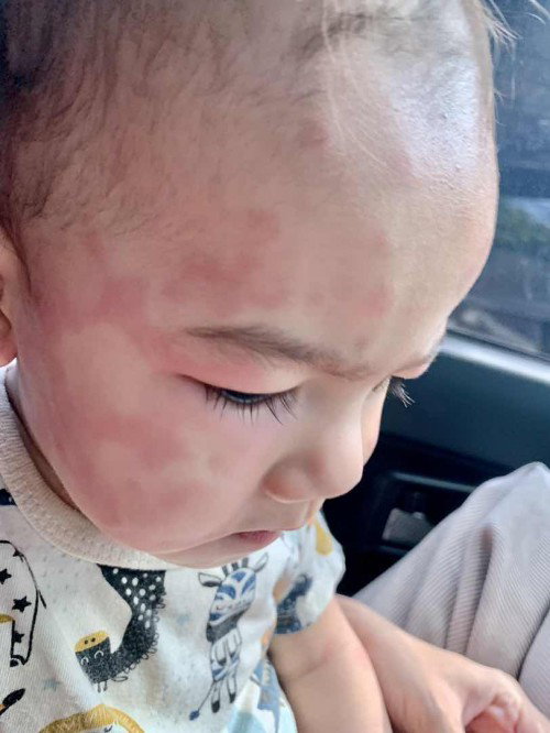 Baby naik ruam merah satu badan