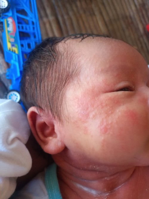 rashes?ba ito mga momshie ano ang gamot nito?