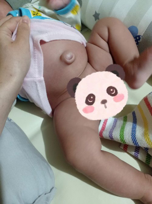 Pusar bayi 1,5bulan bodong