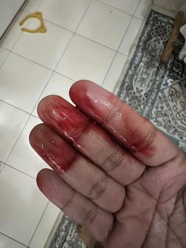 Dah buntu..dah penat ulang Alik hospital tp xde kesudahan... bleeding tp tak aktif