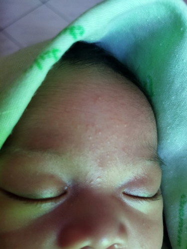 Ruam pada bayi