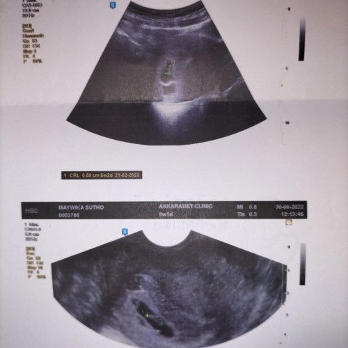 เจอตัวเด็กแต่ไม่ได้ยินเสียงหัวใจ6W3D