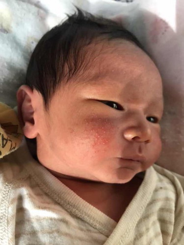 สอบถามแม่ที่มีประสบการณ์ ลูกเป็นผดผื่น