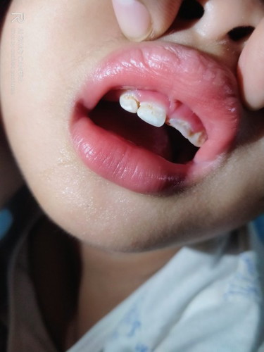 need help anu po kaya dpat gawin sa ngipin ng baby ko