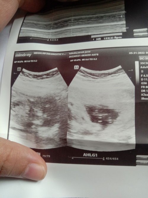 Makikitanong lang po ng gender mga mamsh. ❤️