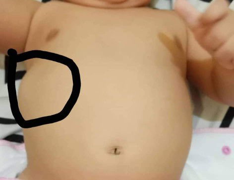 bukol/ maga sa bandang ribs