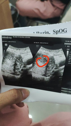 Bun saya mau nnya, di hpht usia kehamilan sy 1 bulan.. Tp pas usg kok kata dokternya 1 minggu..