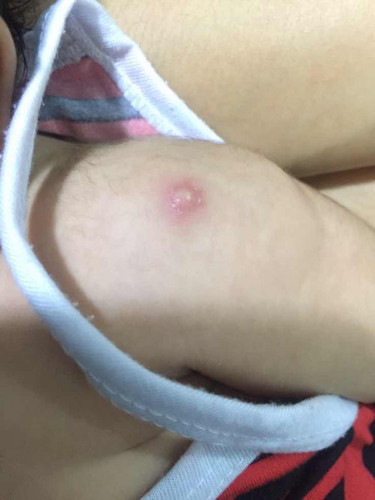 Ask lang mga mii napansin ko lng may ganyan sa braso baby girl ko 1month old palang po kc sya