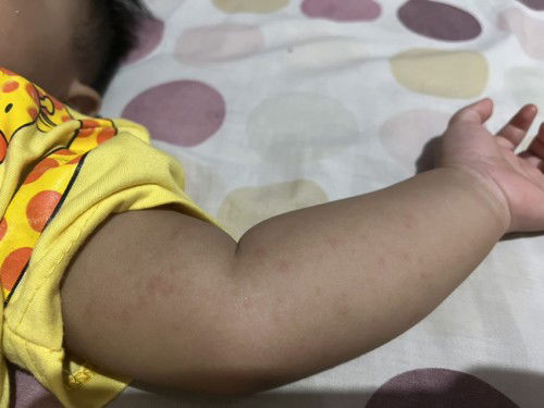 Bintik merah pada tangan dan punggung