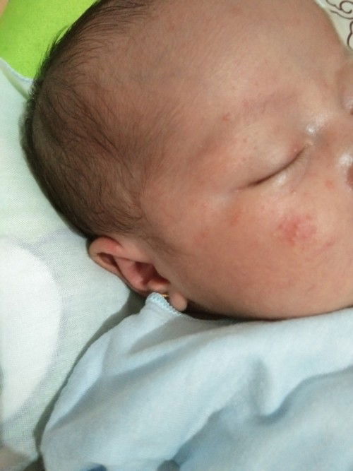 Bintik merah di muka