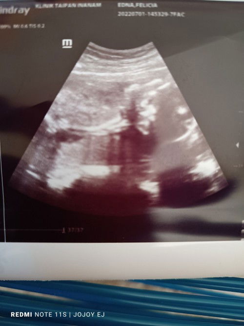 ramalan 80% girl,20%boy scan kat klinik swasta