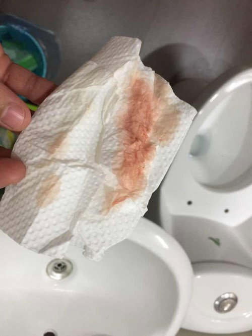Bleeding after check up