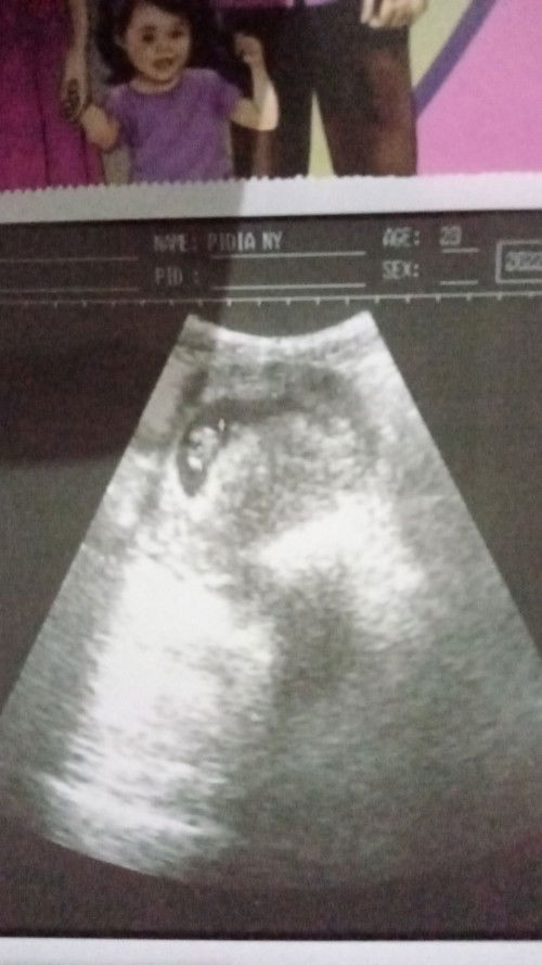 Hasil usg usia 7 minggu